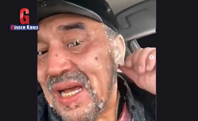 Τα αυτιά ενός άνδρα παγώνουν από το κρύο στο Καζακστάν